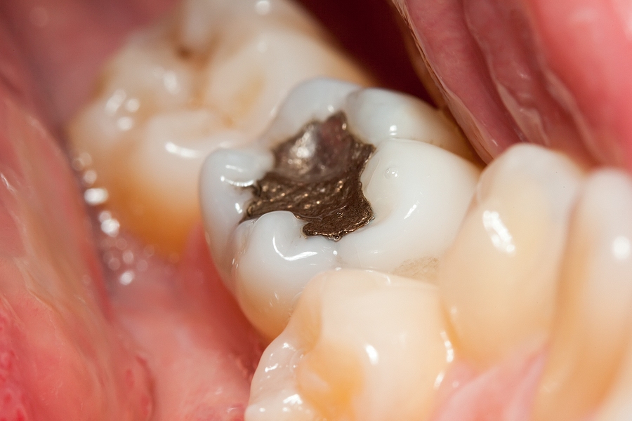 Everything You Need to Know About Dental Fillings: Your Guide to a Healthier Smile
