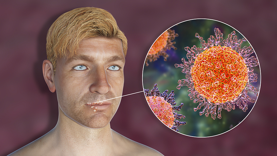 What to Do When You Have a Cold Sore?