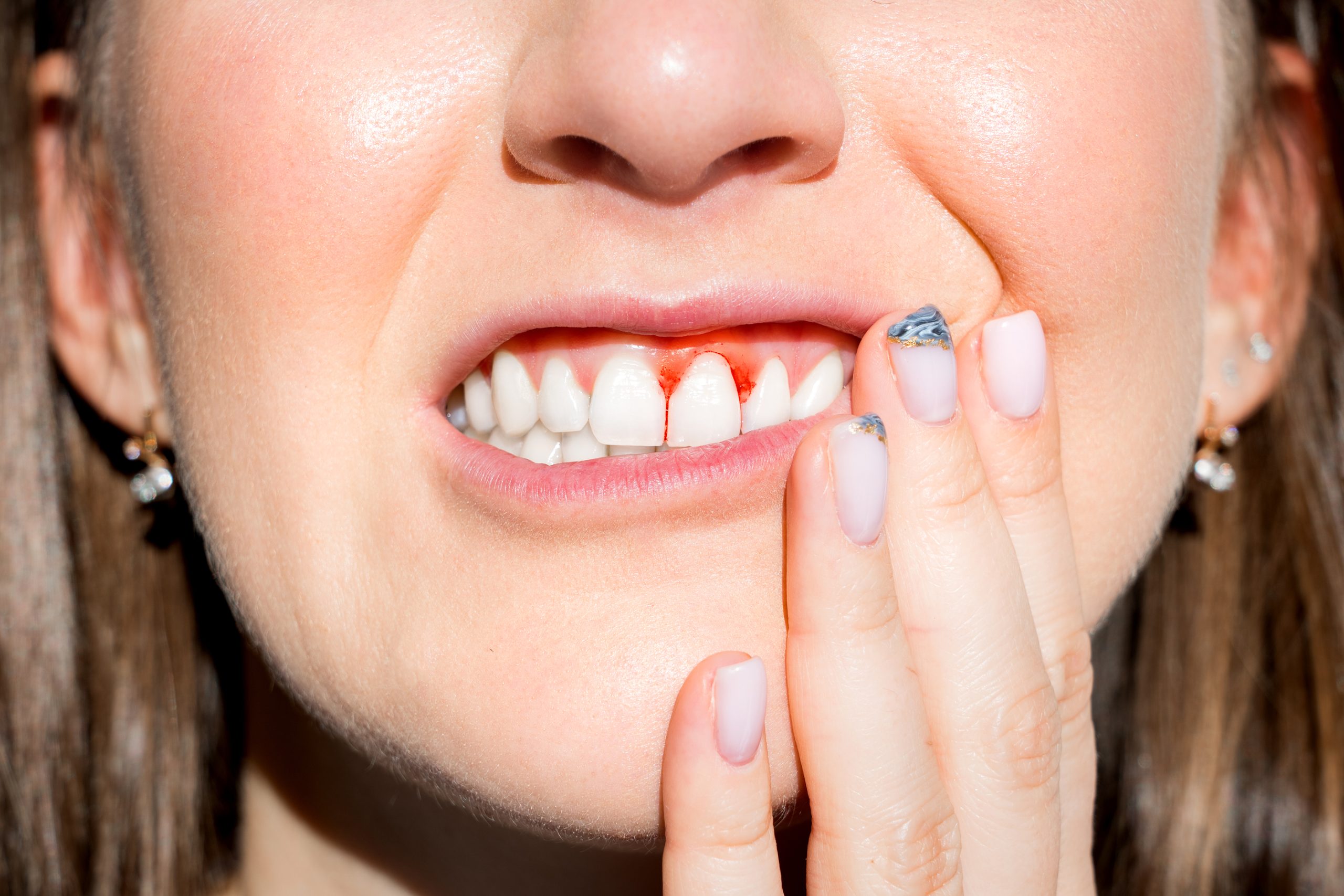 What Is Gingivitis?