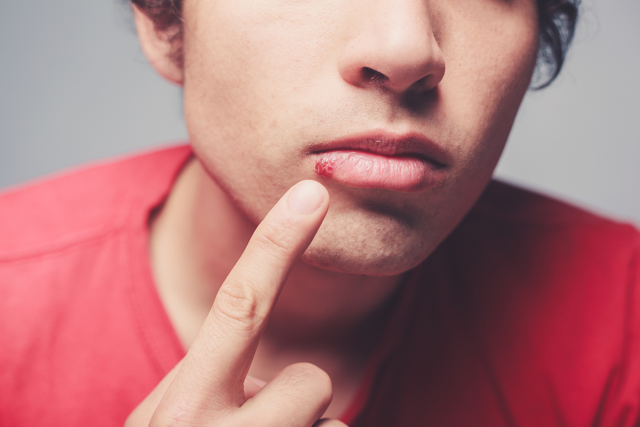 Effective Cold Sore Removal with Laser Technology in Stansbury Park, UT